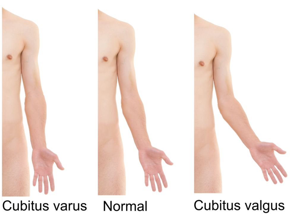 1200px-Cubitus_varus_and_cubitus_valgus.thumb.png.2623ccb356fe63cb0e33baf4cf01d5c3.png